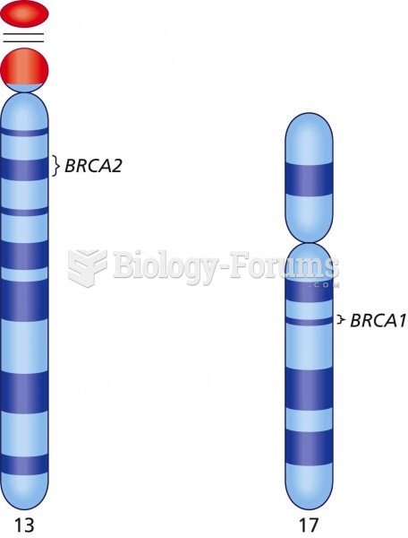 The chromosome locations for BRCA1 and BRCA2. Together, these genes account for the majority of case