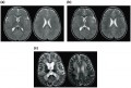 Gene therapy can prevent progression of metachromatic leukodystrophy