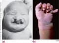 (a) An infant with trisomy 13, showing a cleft lip and palate (the roof of the mouth). (b) The hand