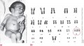 (a) An infant with trisomy 18. (b) A trisomy 18 karyotype.