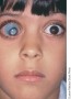 A child with retinoblastoma in one eye