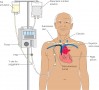 Total parenteral nutrition through a catheter in the right subclavian