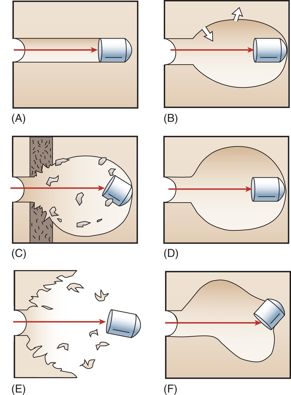 Patterns of tissue injury secondary to gunshot wounds. 