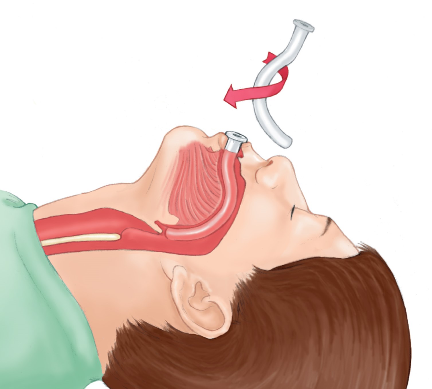 Proper placement of oropharyngeal airway.