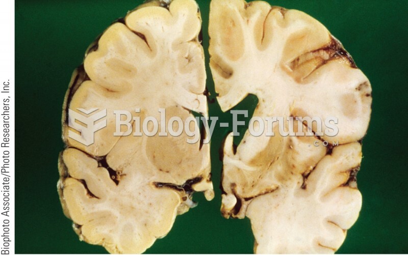 Section of a normal brain (left) and an HD brain (right). The HD brain shows extensive damage to the
