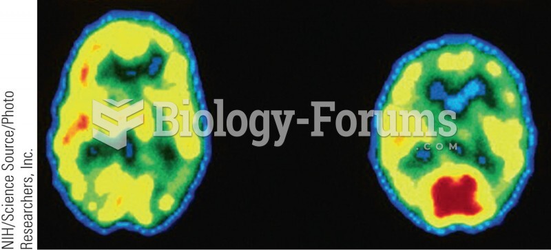 Brain metabolism in a schizophrenic individual (left) and a normal individual (right). These scans o