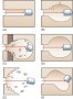 Patterns of tissue injury secondary to gunshot wounds. 