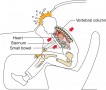 Typical injuries of an unrestrained driver.