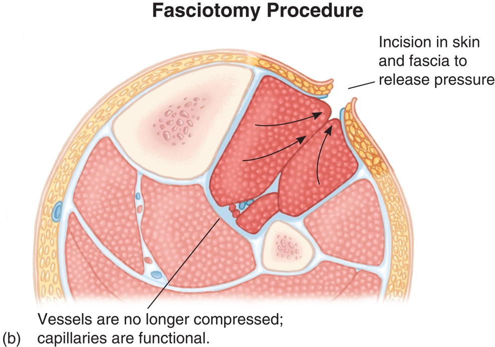 Compartment Syndrome Relieved by Fasciotomy