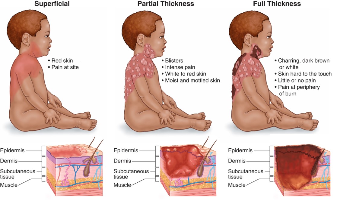 Classification of Burns by Depth