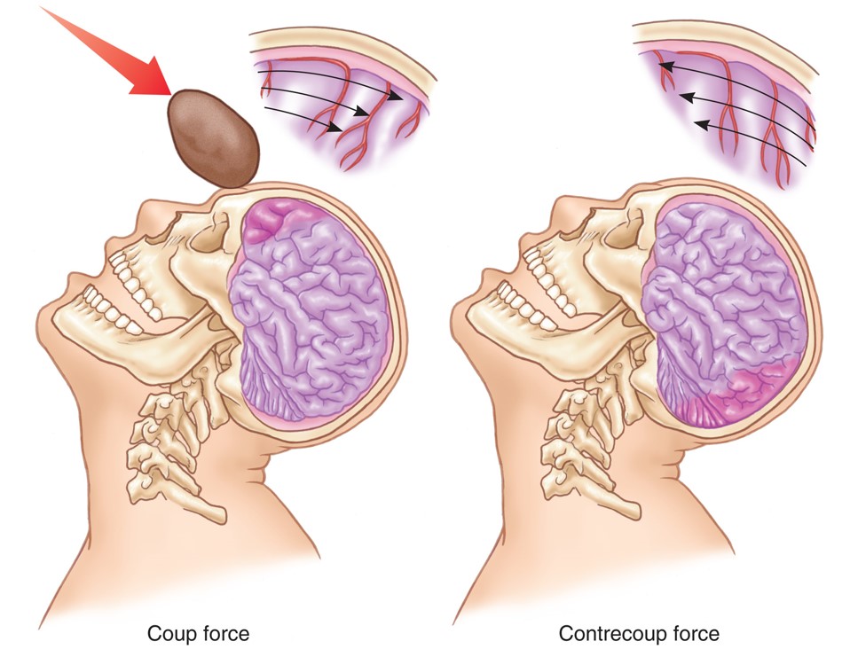 Coup and Contrecoup Movement of the Brain