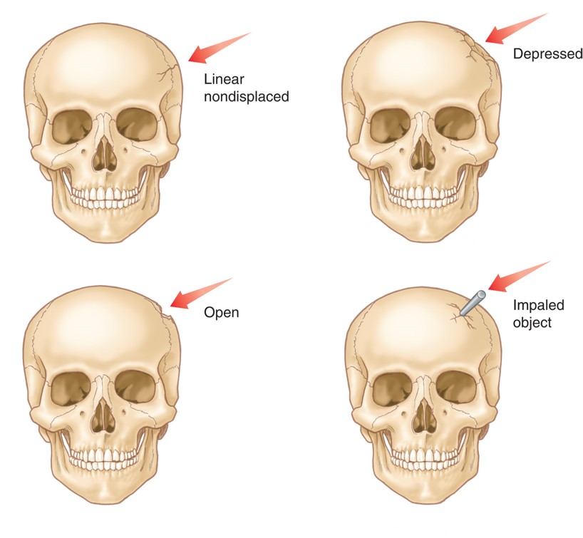 Various Types of Skull Fractures