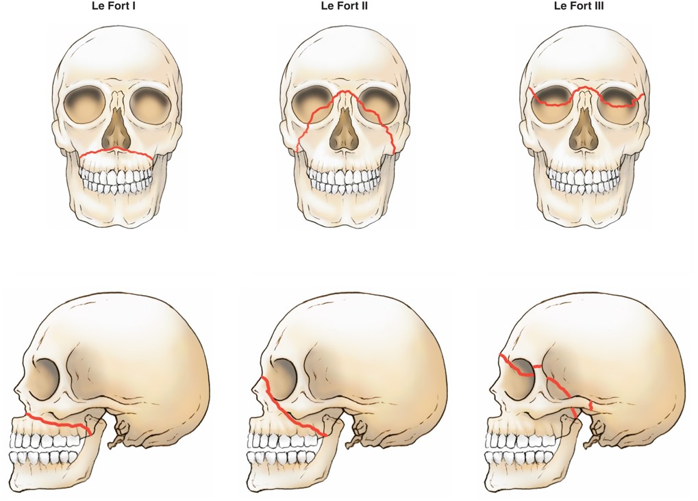 Le Fort Facial Fracture Classification