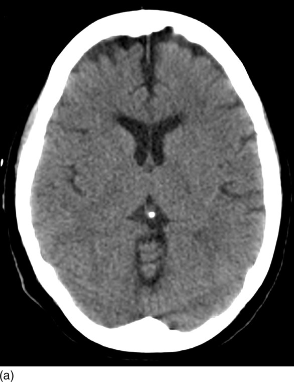 Axial C T of the Brain