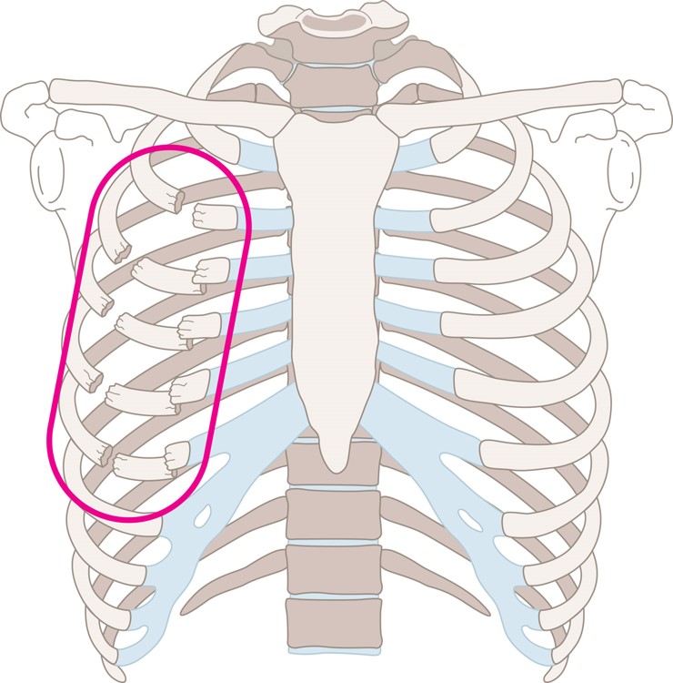 Flail Chest Occurs When Three or More Adjacent Ribs Fracture in Two or More Places