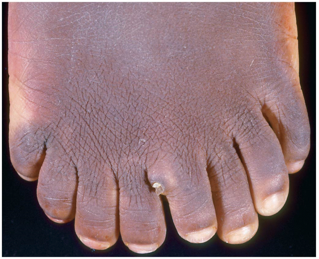 Mutations in posterior Hox genes (HOXD13 in this case) in humans