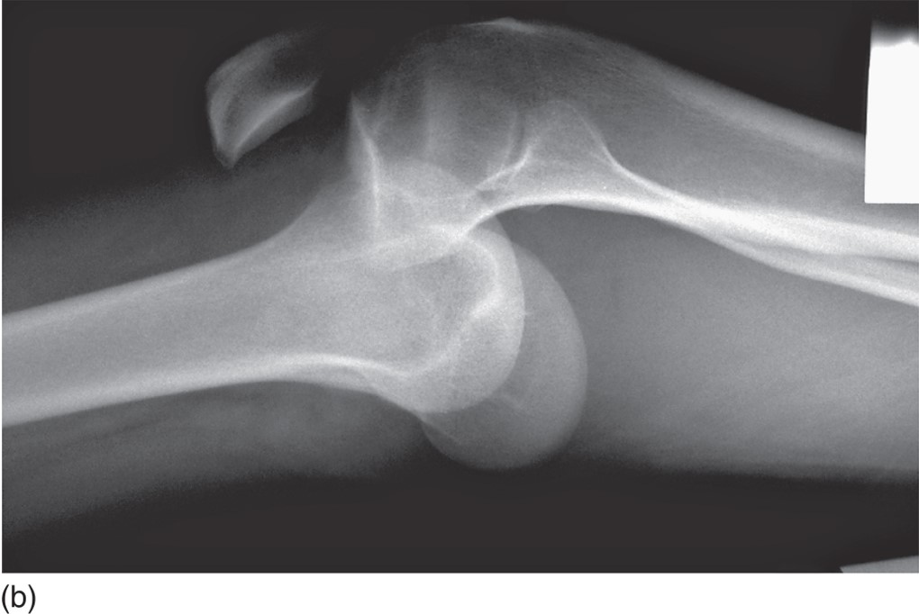 Knee Dislocation. X-Ray of the Dislocation