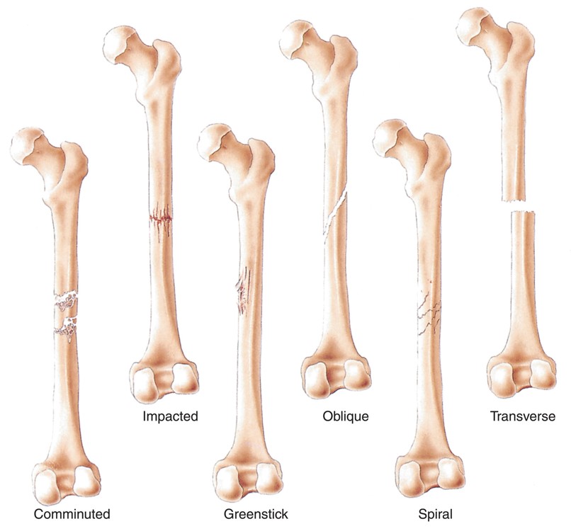 Types of Fractures