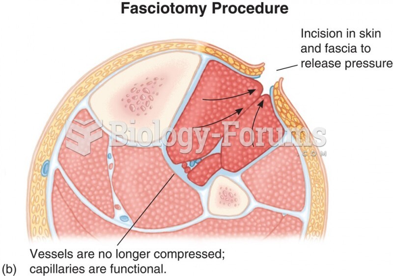 Compartment Syndrome Relieved by Fasciotomy