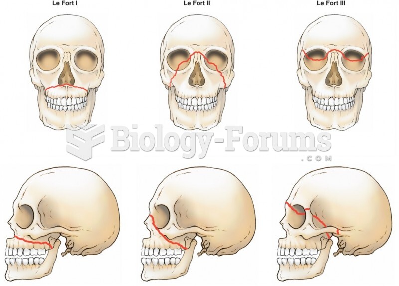 Le Fort Facial Fracture Classification