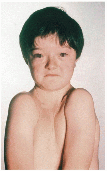 A boy affected with cleidocranial dysplasia (CCD)