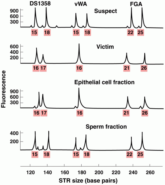 Electropherogram showing the STR profiles of four samples from a rape case