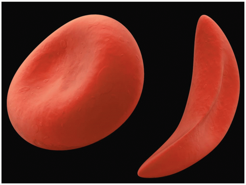 A comparison of a normal erythrocyte with sickle-cell anemia