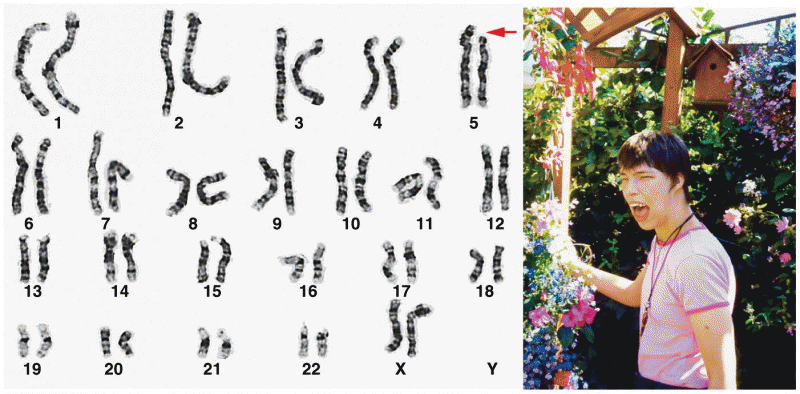 A representative karyotype and a photograph of a child 