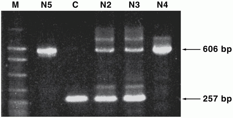 PCR screens of Navajo affected with albinism (N4 and N5) and the parents of N4 (N2 and N3)