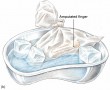 For Transport, Put the Amputated Part in a Dry, Sealed Bag and Place It in Cool Water That Contains