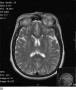 Axial M R I of the brain