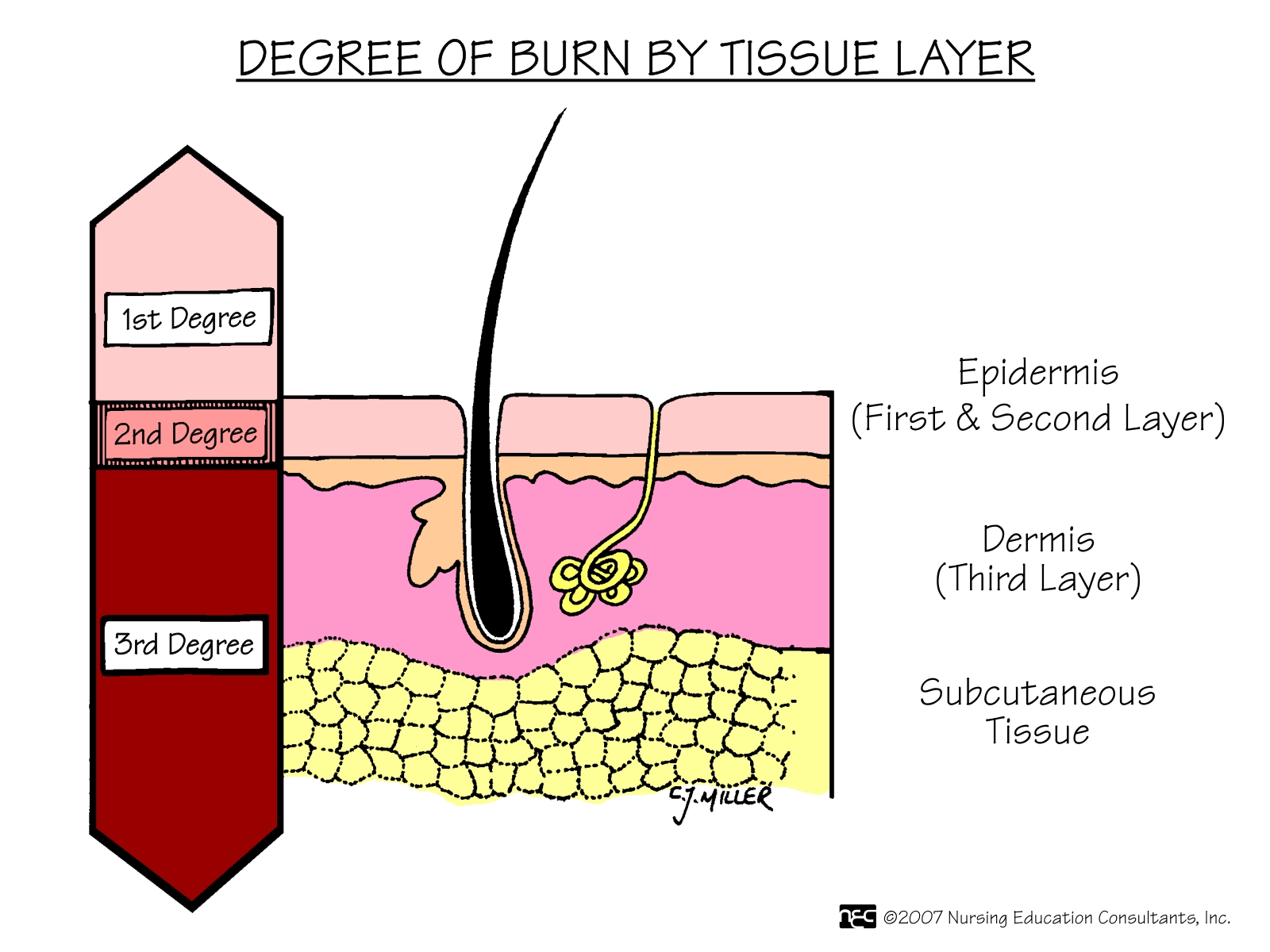 Burn Degree By Tissue Layer