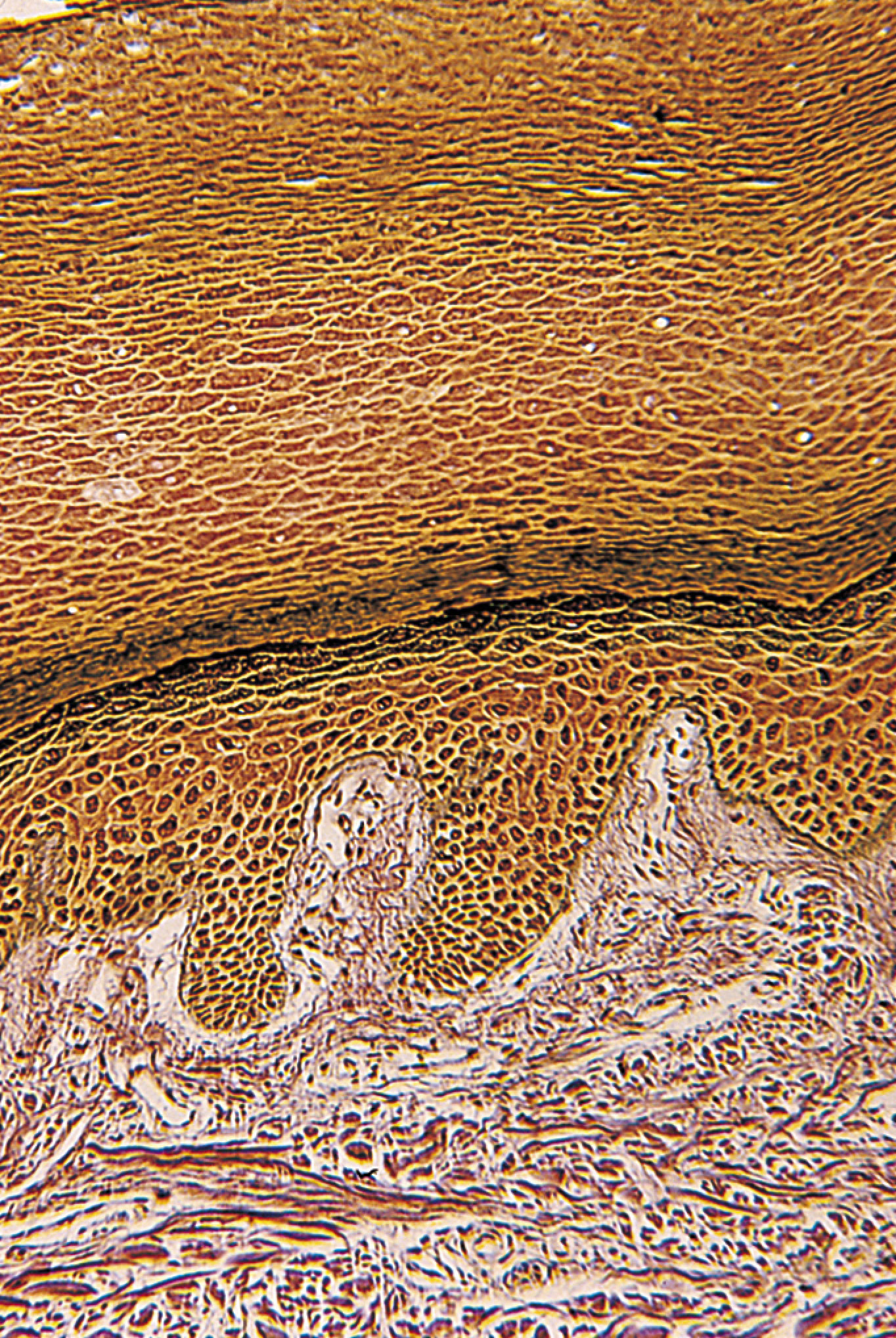 The photo is a cross-section of thickened human skin