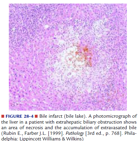 Bile Infarct