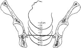 Ischial spine