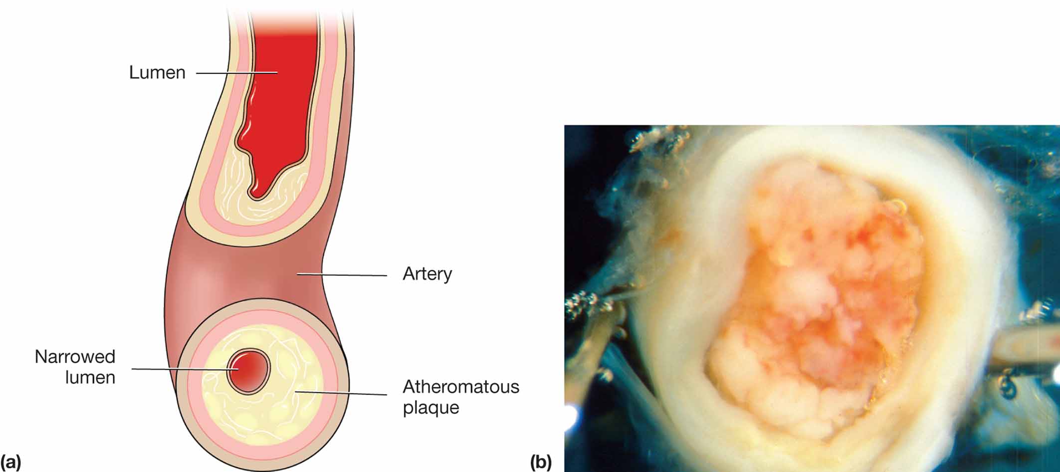 Severe atherosclerotic plaque in an artery.