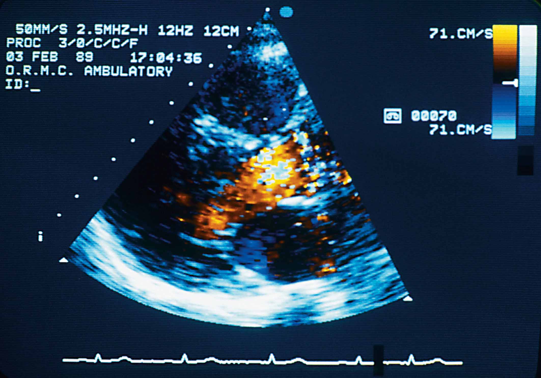 Echocardiogram.