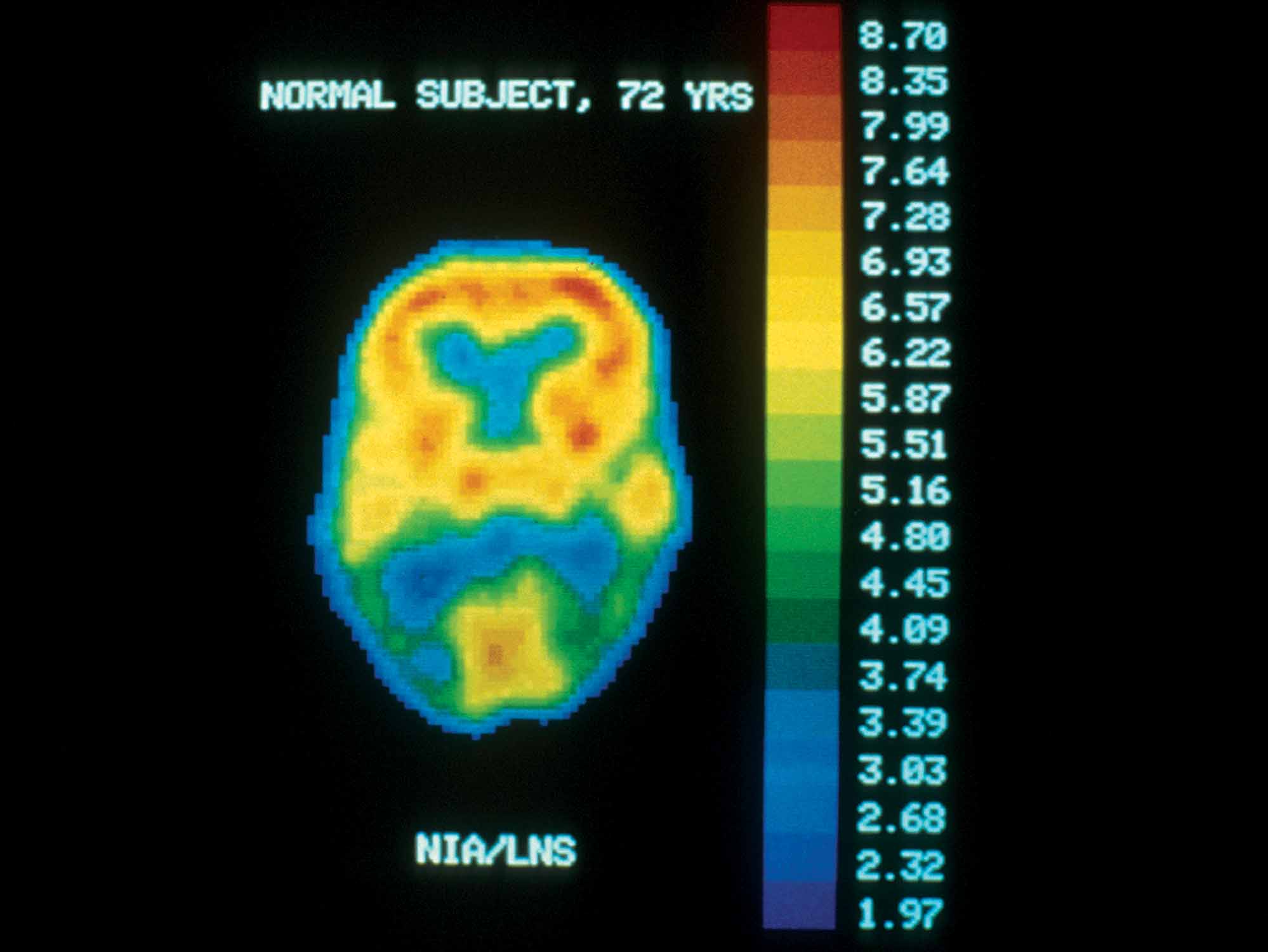 PET scan of a normal brain.