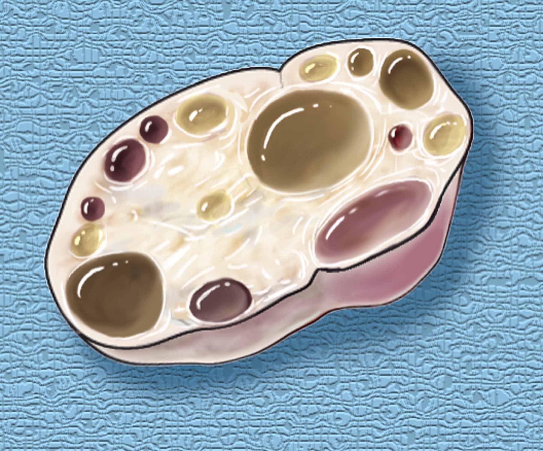 Polycystic ovary syndrome.