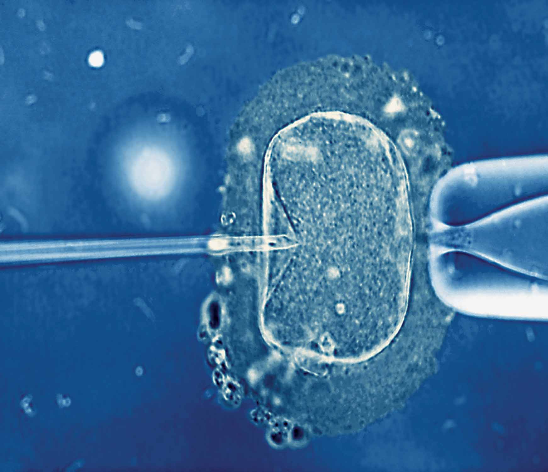 Intracytoplasmic sperm injection (ICSI).