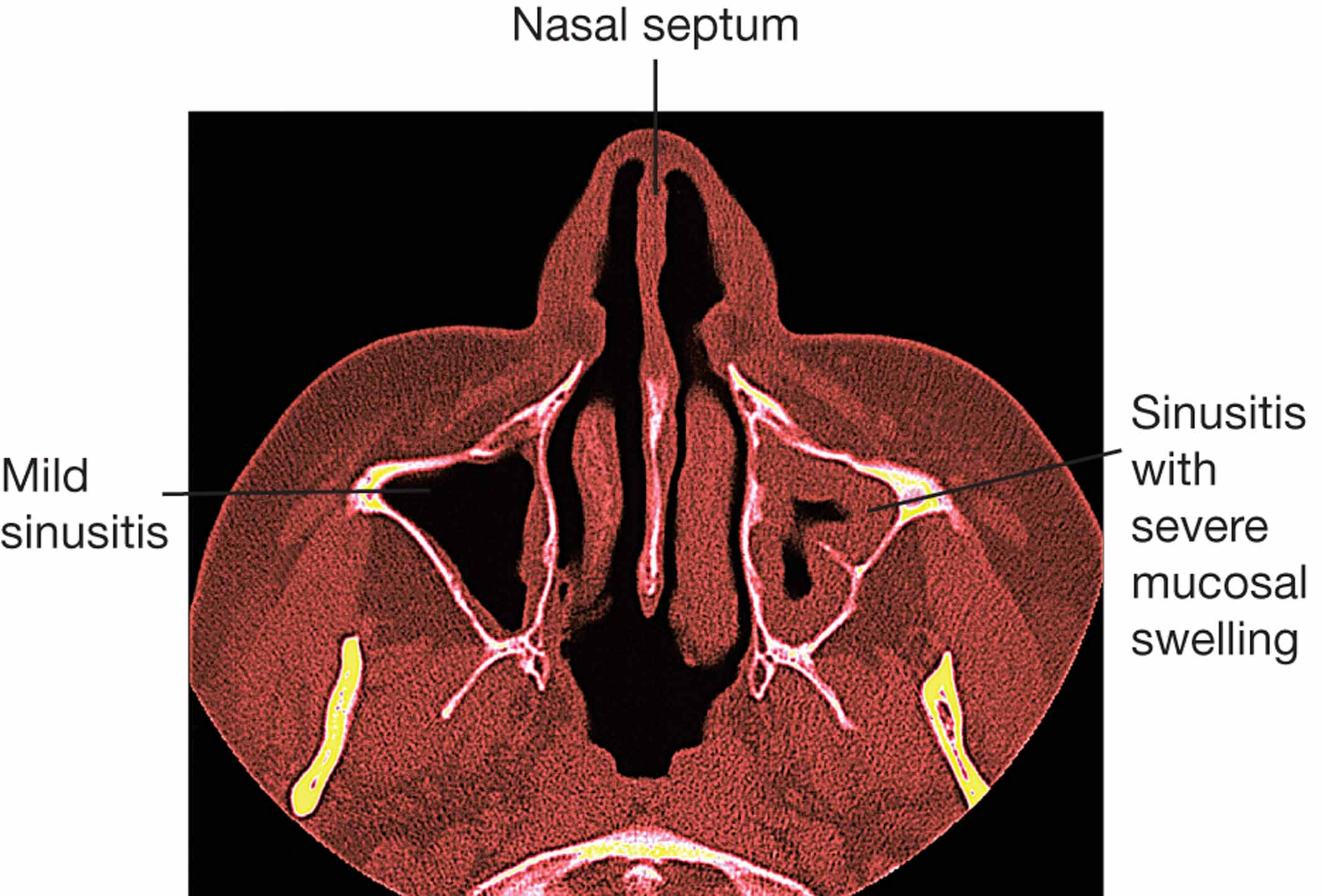 Sinusitis.