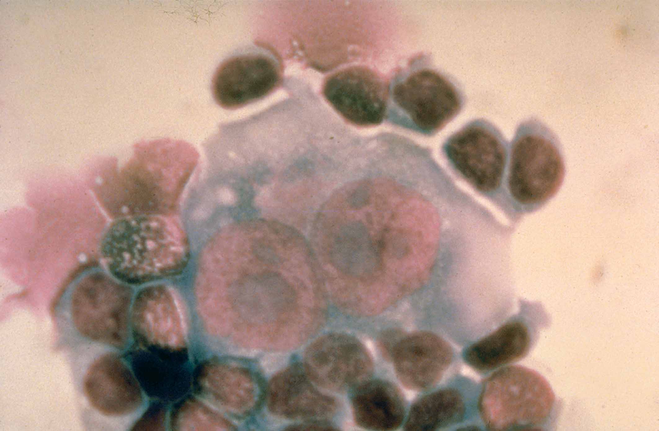 Reed-Sternberg cell.