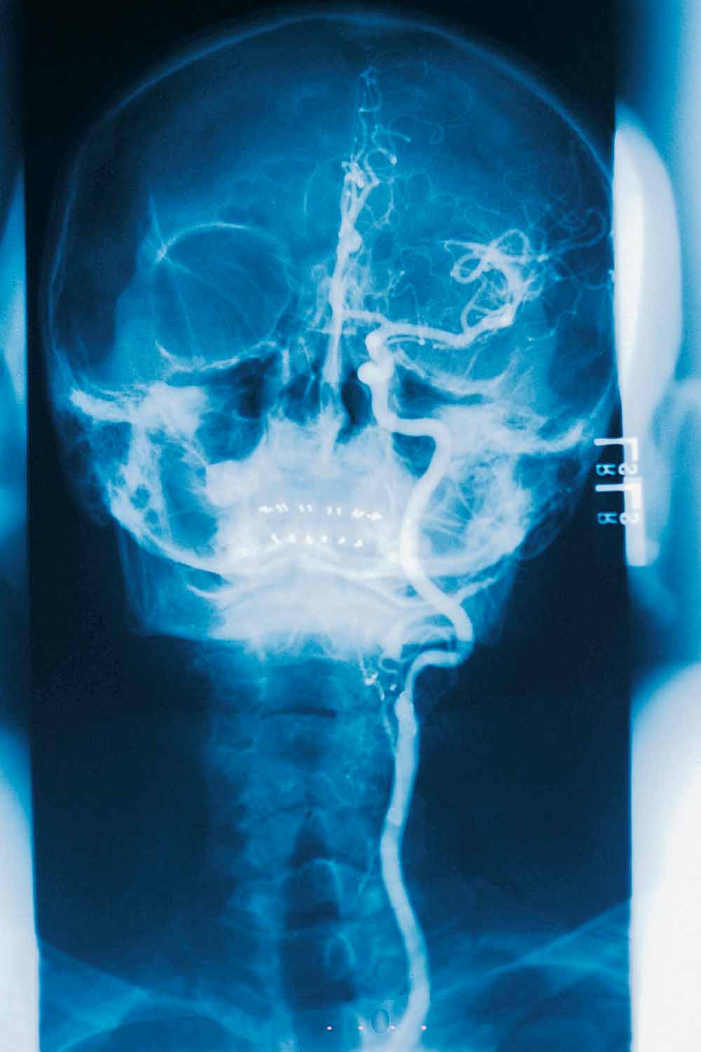 Arteriogram of the left carotid artery and cerebral arteries.