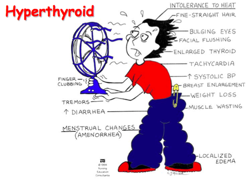 Hyperthyroidism