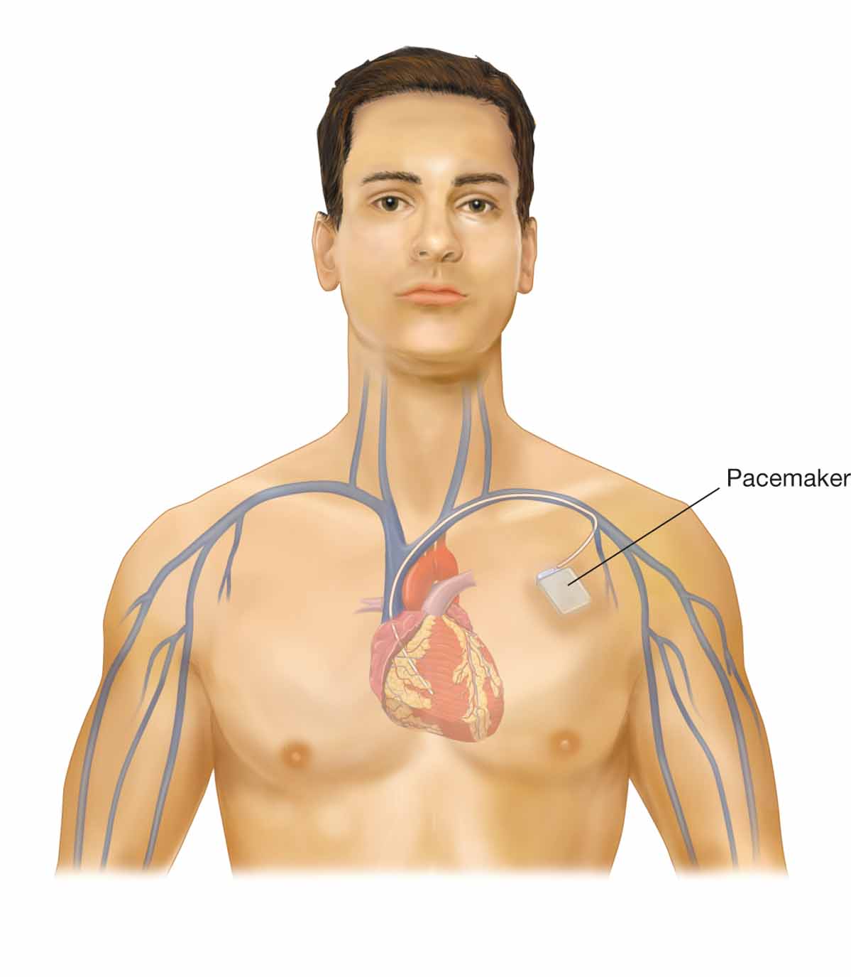 A permanent epicardial pacemaker. The pulse generator can be placed in subcutaneous pockets in the s