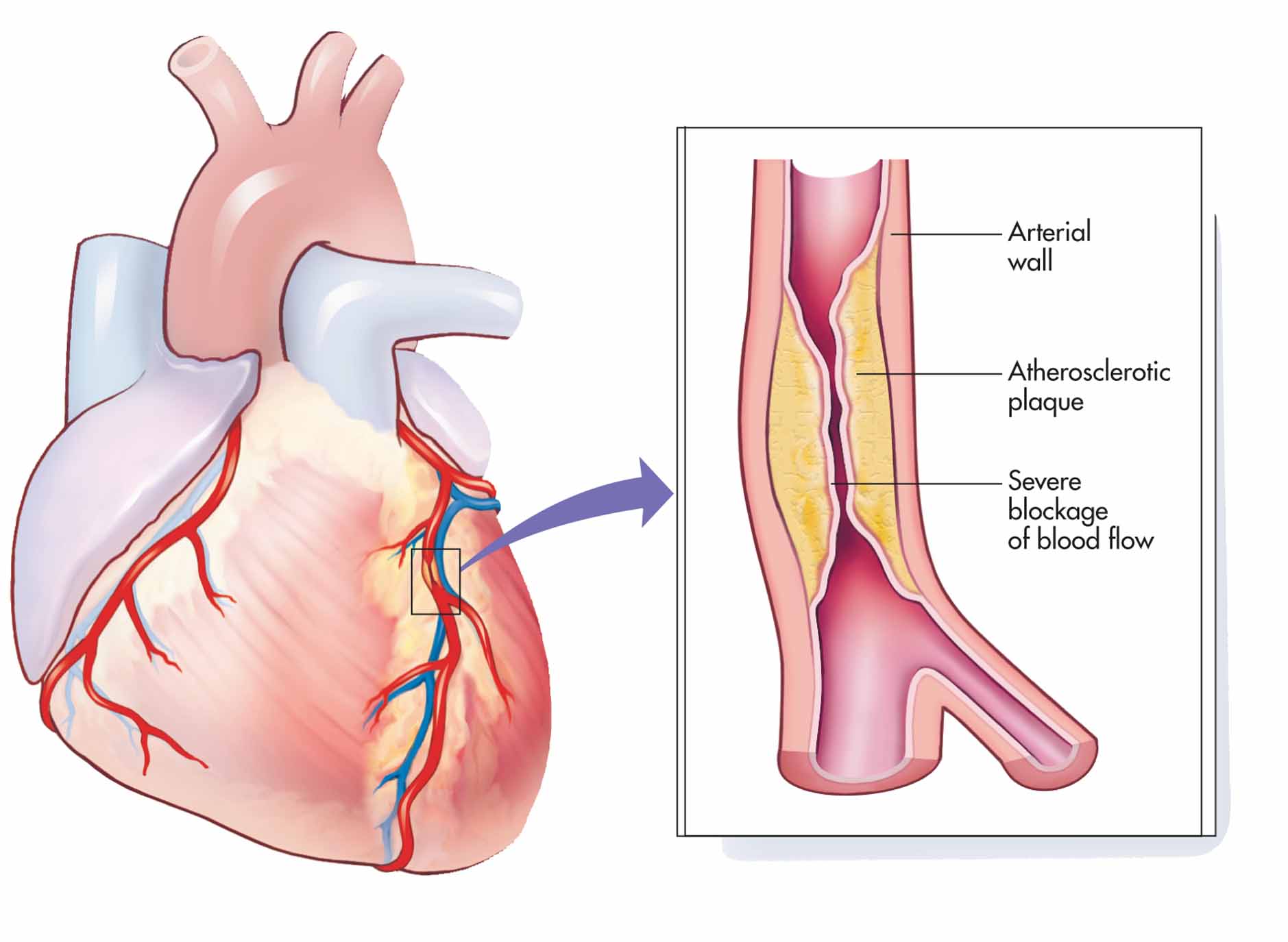 Atherosclerotic artery.