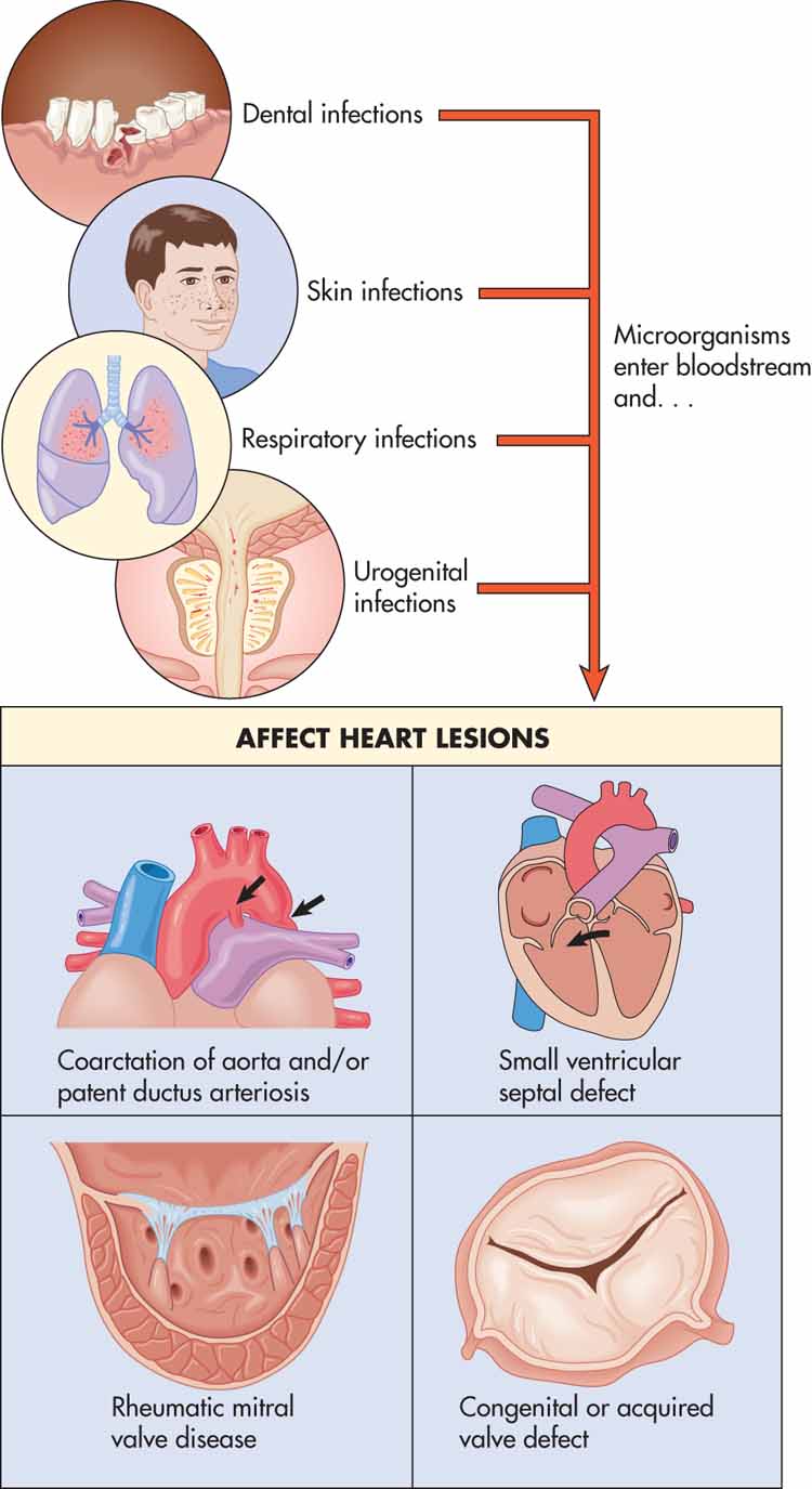 Cause of bacterial endocarditis