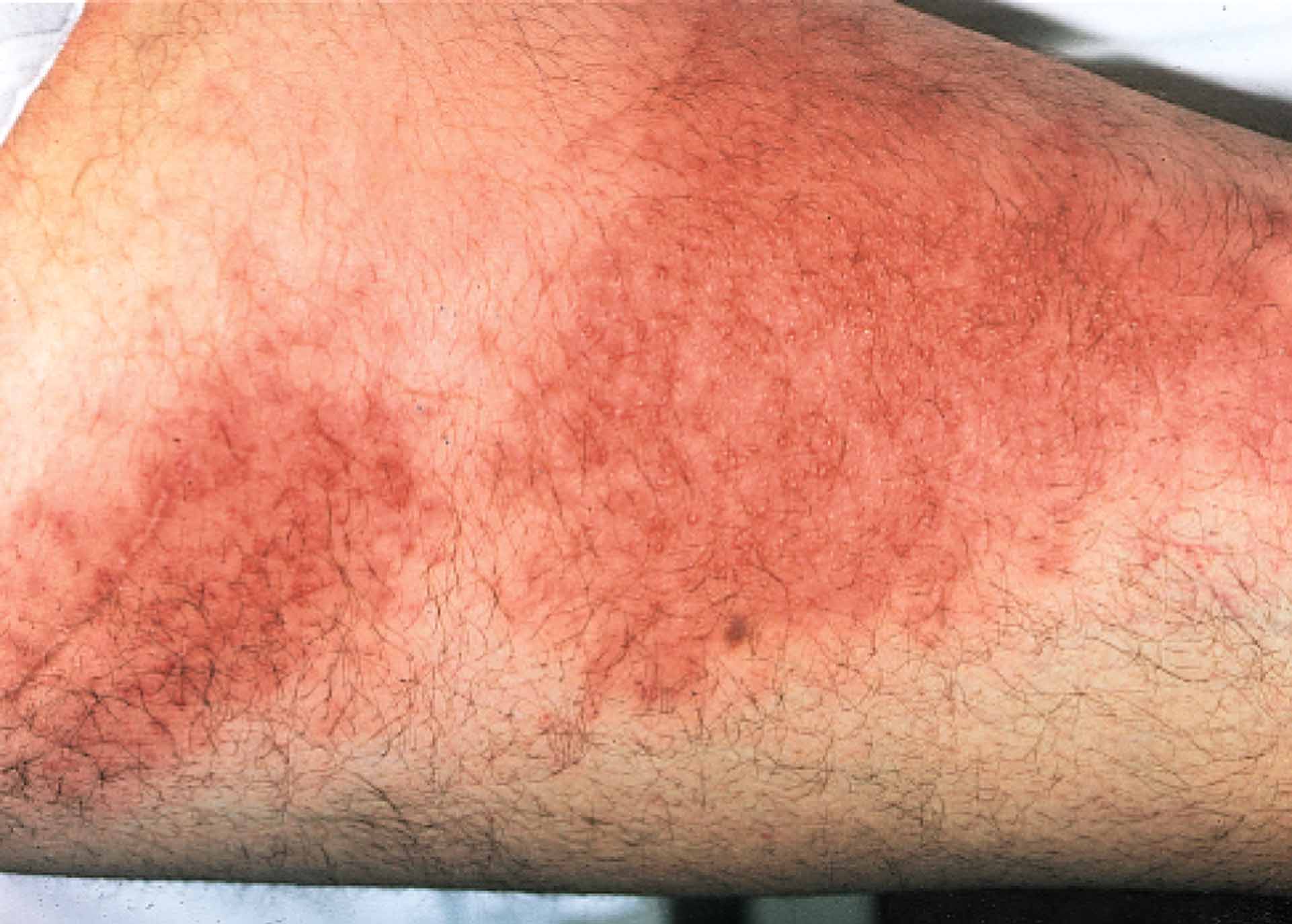 Thrombophlebitis.