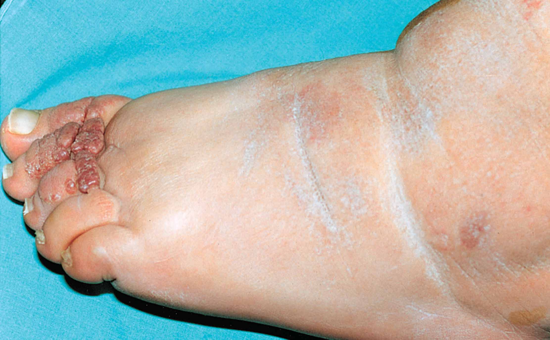 Chronic lymphedema. 