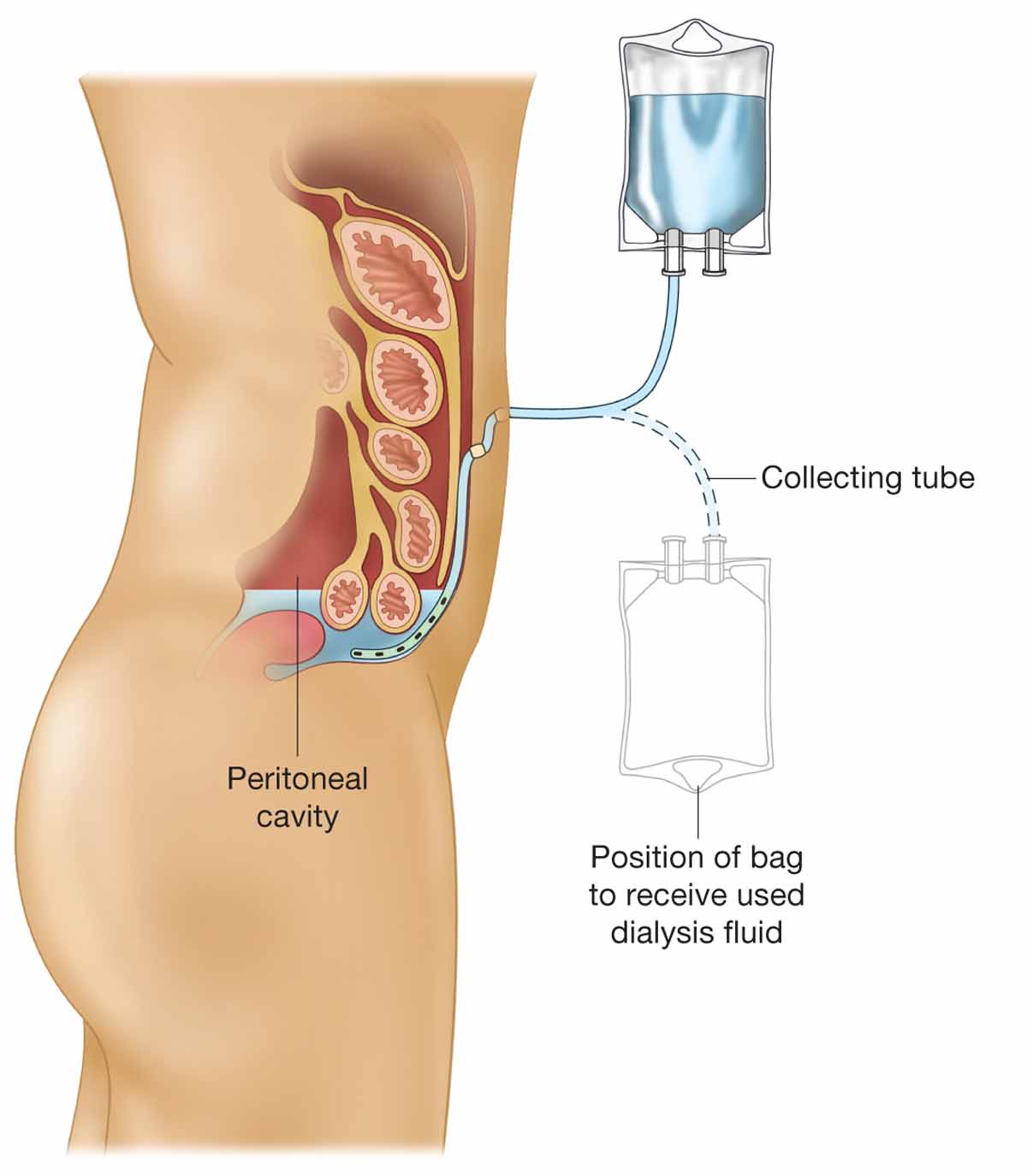 Peritoneal dialysis.